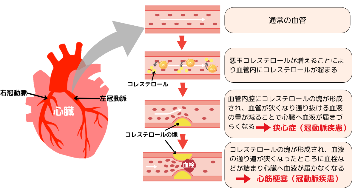コレステロールと心臓病